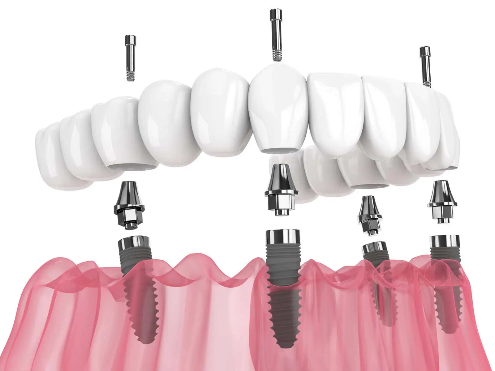 All-on-4 full-arch implant model