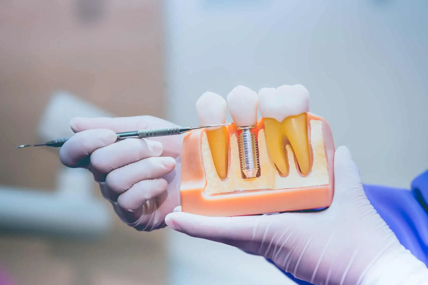 Close-up of a natural-looking dental implant restoration